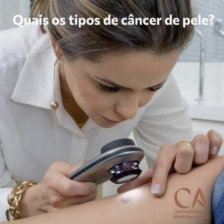 cancêr de pele